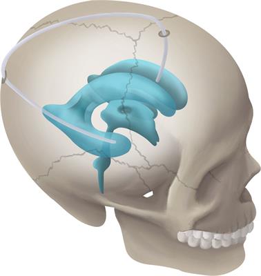 Refined Temporal-to-Frontal Horn Shunt for Treatment of Trapped Temporal Horn After Surgery of Peri- or Intraventricular Tumor: A Case Series Study